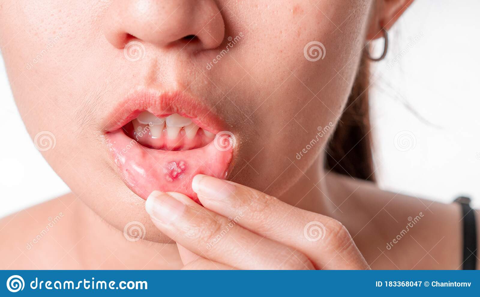 asian-women-have-aphthous-ulcers-mouth-white-background-selective-focus-183368047.jpg